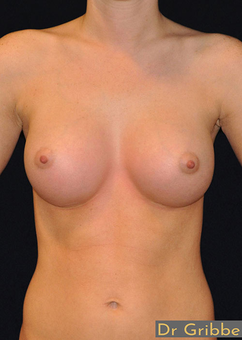 Anatomiska implantat efter operation