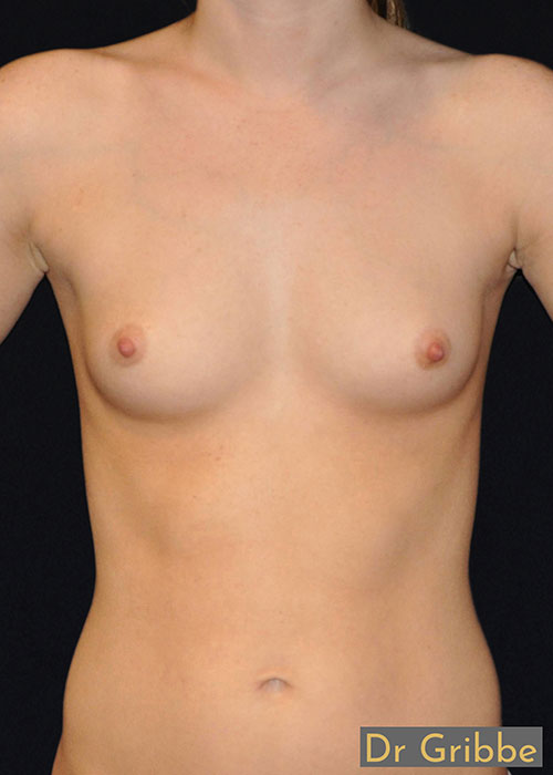 Anatomiska implantat före operation