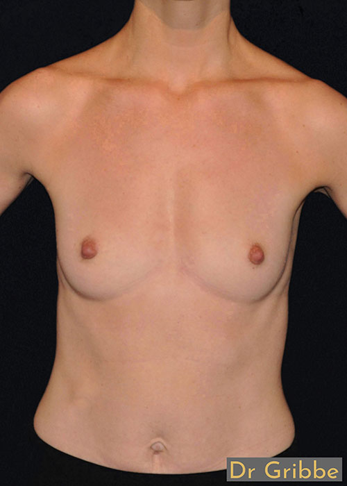 Runda implantat före operation