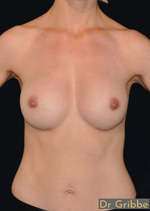 Runda implantat implantat efter operation
