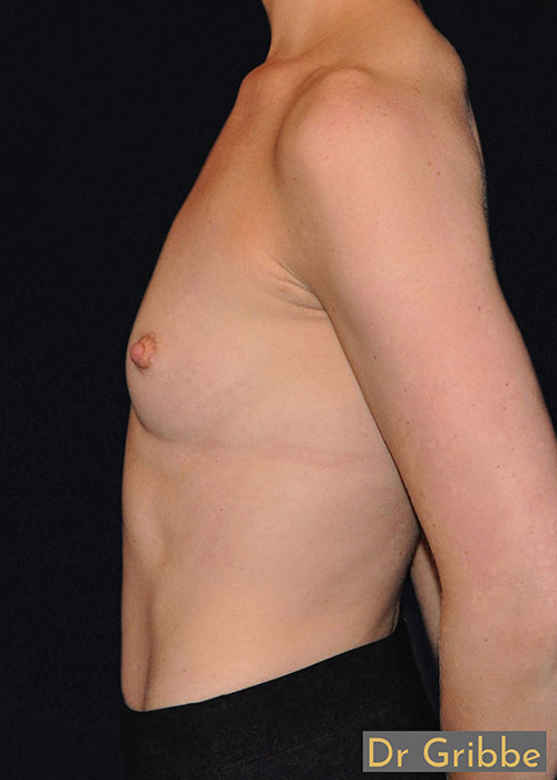Runda implantat före operation
