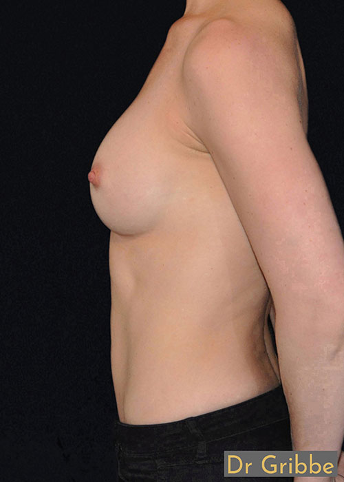 Anatomiska implantat efter operation
