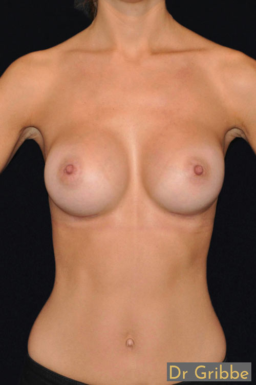 Runda implantat implantat efter operation